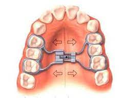 maxillary expansion