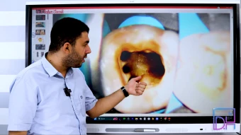 Endodontics - كامل منهج الفرقة الثالثة دفعة 2025